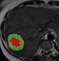 Masterclass in Imaging of Hepatobiliary Tumours